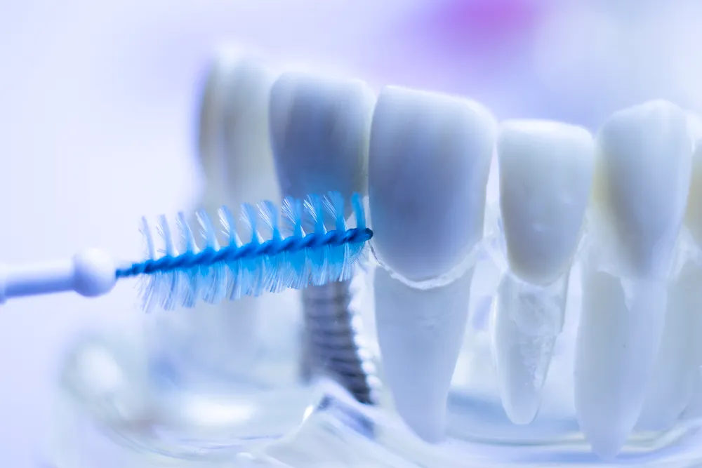 Ang Mga Benepisyo ng Interdental Brushes para sa Ngipin
